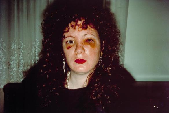 Nan one month after being battered 1984 by Nan Goldin born 1953